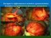 Липосакция - После потери веса3