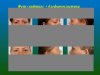 Липосакция - После потери веса4